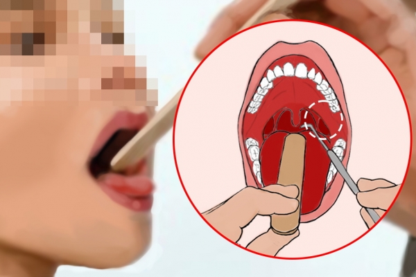 扁桃体发炎一直不好怎么办 如何预防和治疗扁桃体发炎