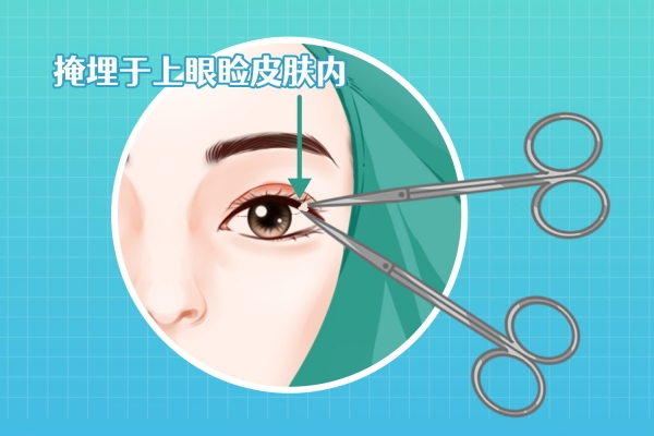双眼皮手术哪里做的比较好的医院 双眼皮手术做的较好的医院推荐
