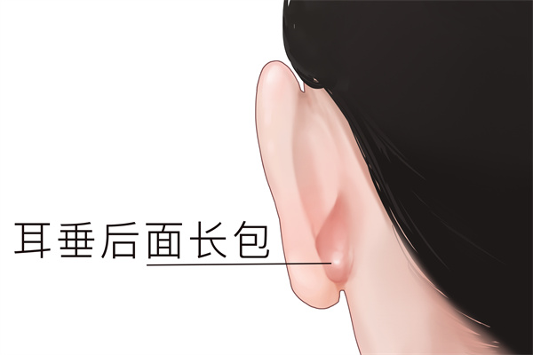 耳朵后面长了个硬包是怎么回事 耳朵后面长了个硬包怎么回事,应该怎么办?