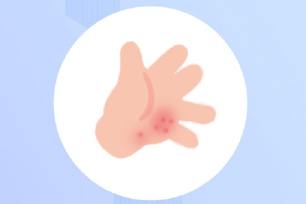 手足口病的治疗 手足口病的治疗用什么药