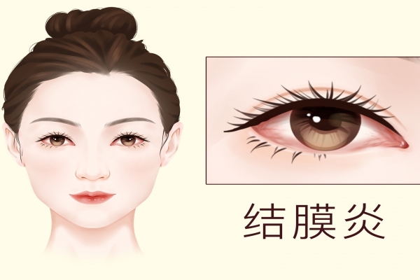 结膜炎能不能吃蒸饵丝