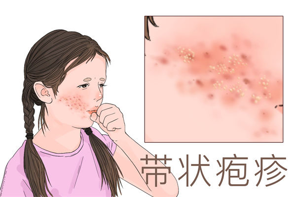 带状疱疹可以吃羊肉吗