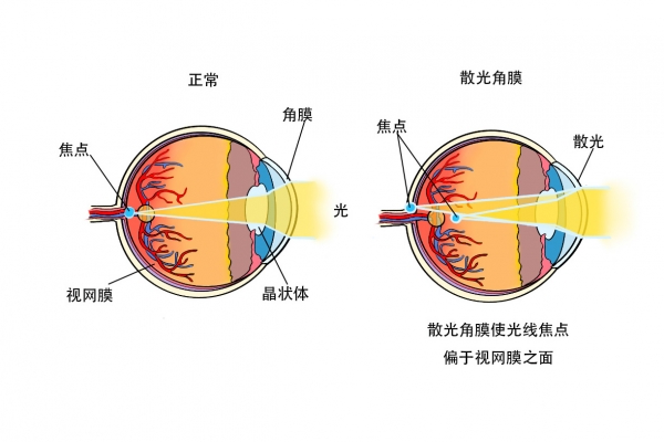 散光是什么意思